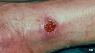 leg ulcer