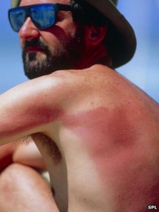 Sunburnt man