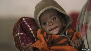 File picture of a four-year-old girl suffering from malnutrition in India
