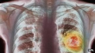 X-ray showing lung cancer