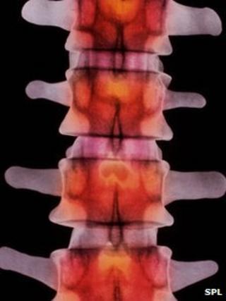 Spine