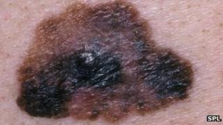 Skin cancer