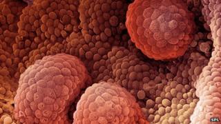 Prostate cancer