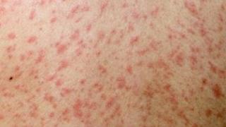 Measles