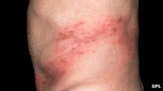 Shingles rash