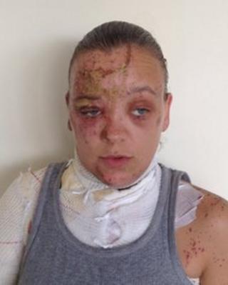 Tara, the acid attack victim