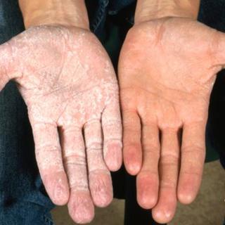 Skin condition