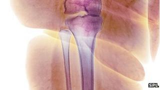 x-ray of leg