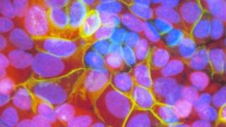 Cancer cells of the human breast