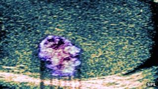 Testicular cancer in ultra sounds scan