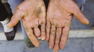 Arsenic exposure