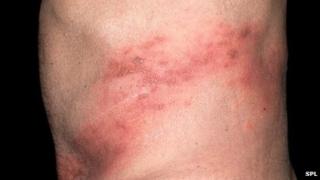 Shingles rash
