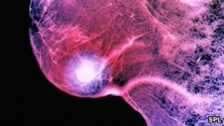 Breast cancer