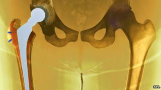 A hip replacement
