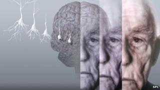 Alzheimer's brain