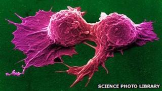Breast cancer