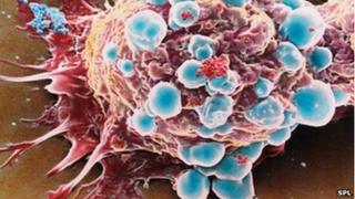 Breast cancer cell