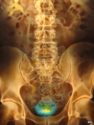 Bladder x-ray