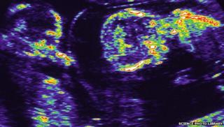 Twins in the womb