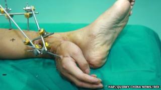pic of the grafted hand