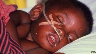Child with severe malarial infection