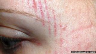 'Footprint' head injury