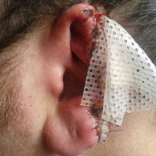Ryan Somerville's ear had to be stitched and he had skin grafts following the attack