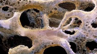 A bone with osteoporosis