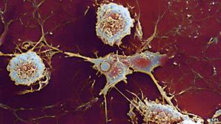 Multiple sclerosis