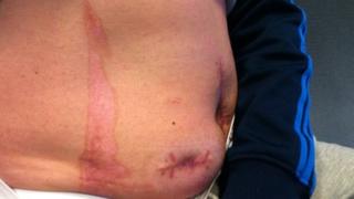 Burn on Paul Hill's stomach