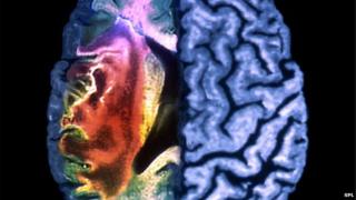 Strokes are most commonly caused by clots blocking crucial blood supply to the brain