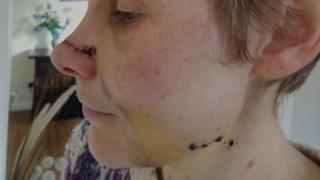 Helen Pearson after the attack