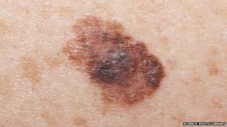 Malignant melanoma
