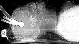 X-ray of Connor Huntley's injury