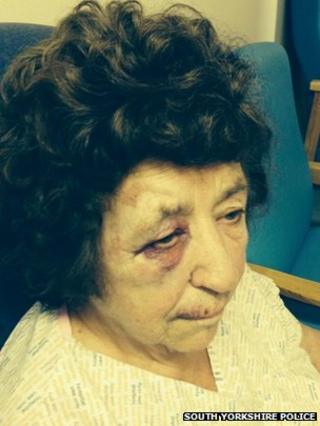 Burglary victim's injuries