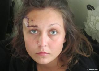 Jasmine Real, 22, required 62 stitches to her forehead