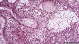 A brain tumour