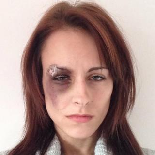 Katrina-Kay Hayward's eye injury on 5 Nov 2014