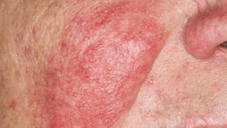 Some people experience redness and swelling when taking certain medicines
