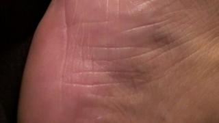 Skin with potential bed sore - generic image