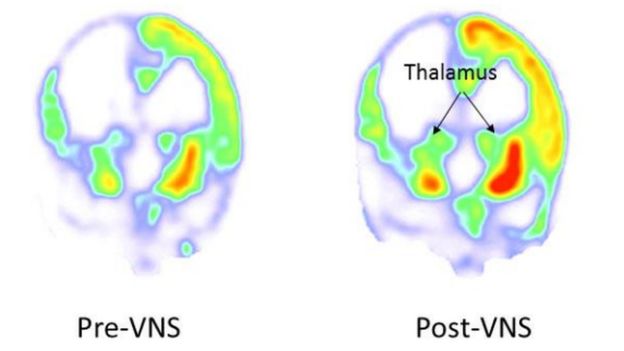 Imagens que indicam em vermelho, verde e amarelo a atividade cerebral