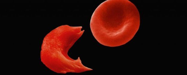 A normal red blood cell next to a sickle cell