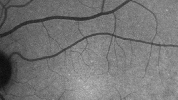 விழியின் பின்புறம் தெரியும் வெள்ளைப்புள்ளிகள், குளுகோமாவால் பாதிக்கப்பட்ட விழித்திரை நரம்பு மண்டலங்கள்