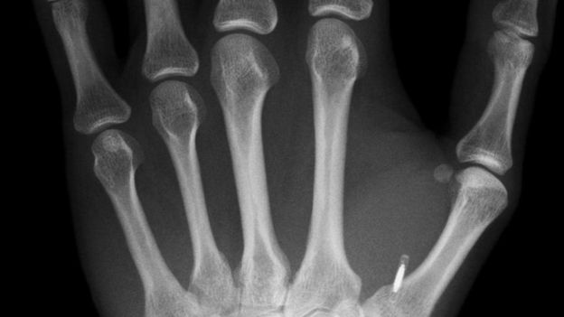 Imagem de raio-x da mão esquerda de Mark Gasson