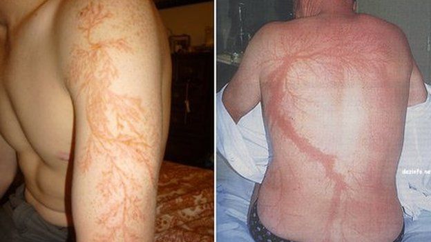 Two photos of men with lightning injuries that look like flower or tree branches