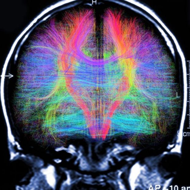 Escán que muestra fibras neuronales en el cerebro