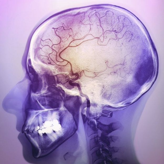 infarto cerebral
