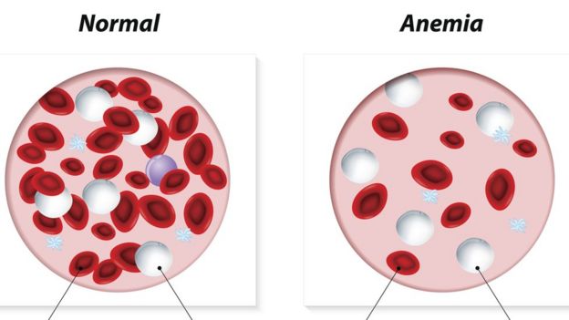 Ilustração mostra a diferença entre amostras de sangue saudável e anêmico