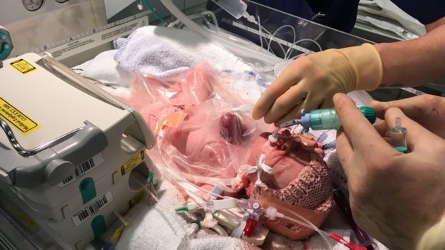 Baby Born with Heart Outside Body 'doing well'. Image copyright: Glenfield Hospital Baby Born with Heart Outside Body 'doing well'. Image copyright: Glenfield Hospital