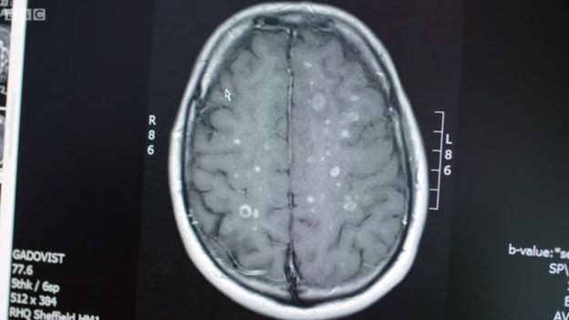 Escáner cerebral de Stephen Storey previo al tratamiento con células madre.